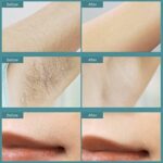 Laser Hair Removal Device for Women & Men - Image 13